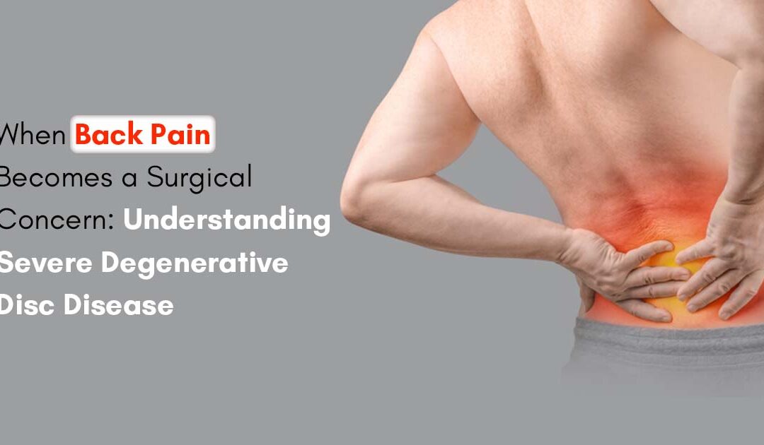 When Back Pain Becomes a Surgical Concern: Understanding Severe Degenerative Disc Disease