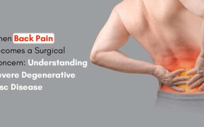 When Back Pain Becomes a Surgical Concern: Understanding Severe Degenerative Disc Disease
